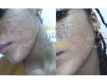 بهبود جوش های صورت