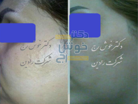درمان لک بارداری