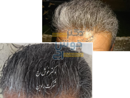رفع سفیدی مو با دکتر خوش رج