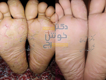 ترک و خشکی کف پا